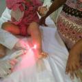 Enfermeira aplica laser terapêutico na perna de criança. #pracegover