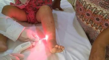 Enfermeira aplica laser terapêutico na perna de criança. #pracegover