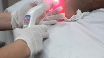 mãos com luvas seguram equipamento que emite luz de laser para um pé sobre uma maca. #paratodosverem 
