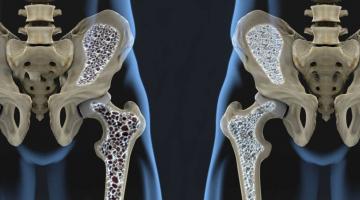 UPA de Santos alerta para osteoporose, a doença silenciosa que provoca 200 mil mortes por ano Brasil