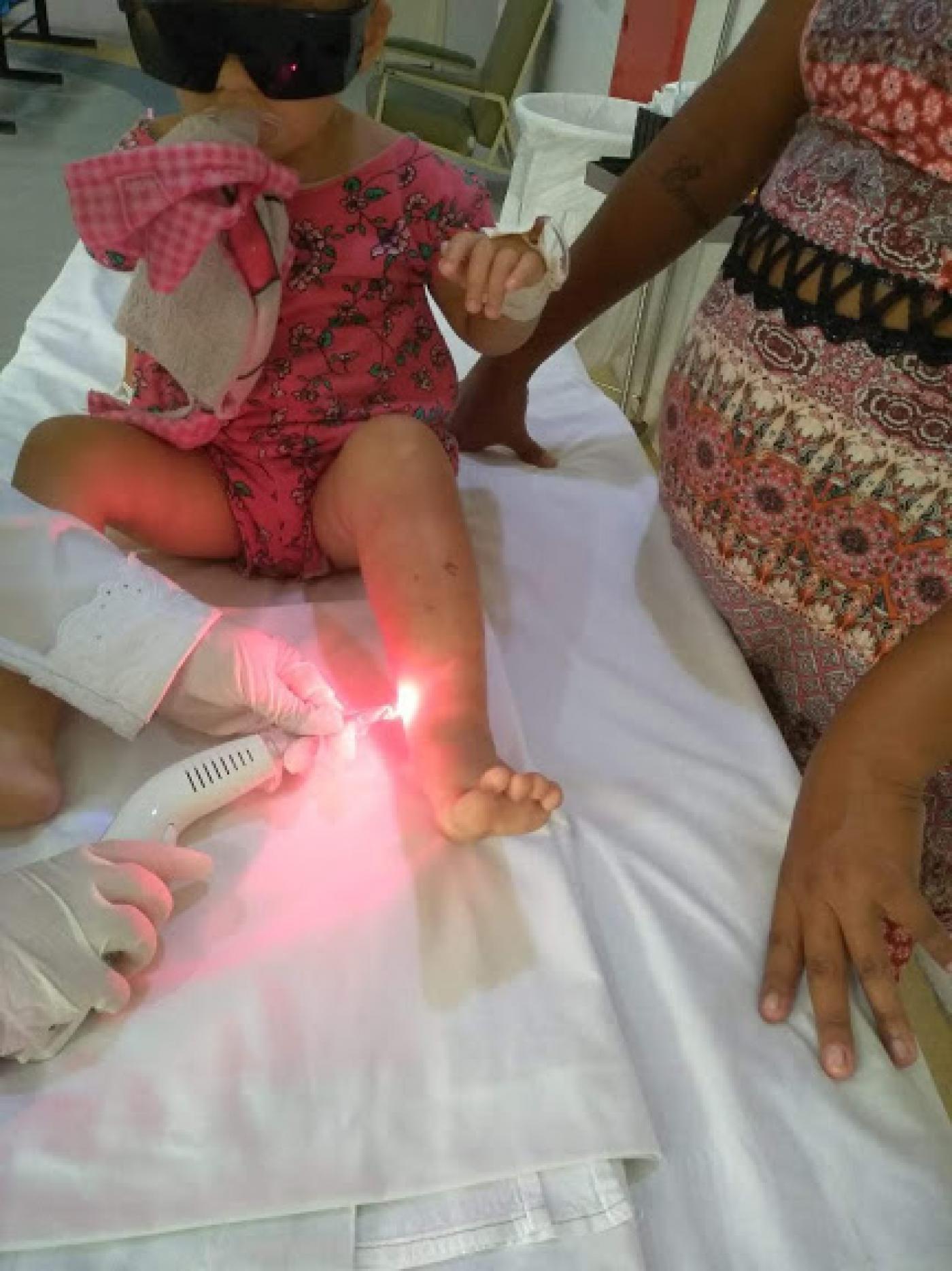 Enfermeira aplica laser terapêutico na perna de criança. #pracegover